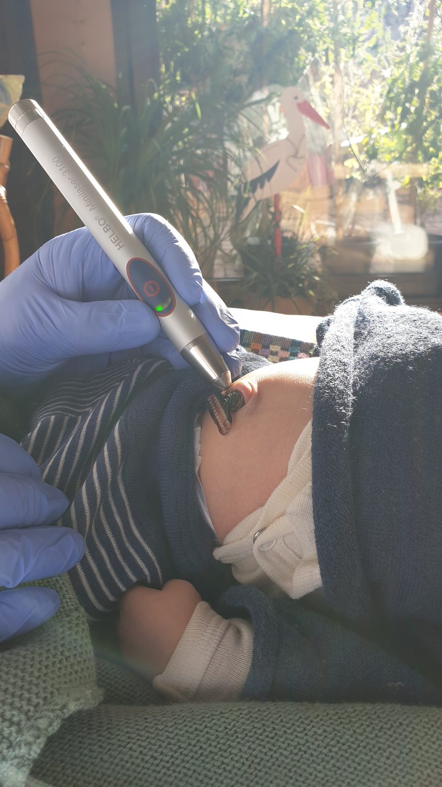 HELBO Minilaser 3100 bei der Low-Level-Lasertherapie am Bauchnabel eines Neugeborenen